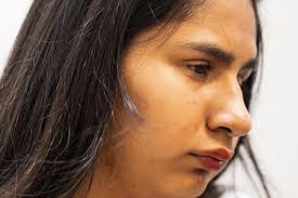 Arlington student gains confidence with prosthetic eyes