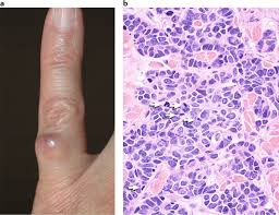 Image result for Merkel Cell Carcinoma