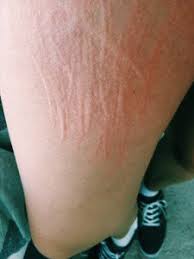 Image result for Dermatographism