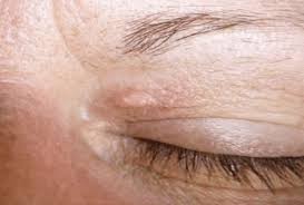 Image result for xanthelasma of eyelid