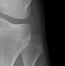 Image result for Segond Fracture