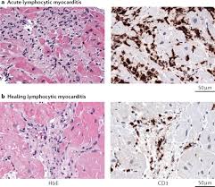 Image result for Myocarditis