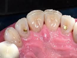 Tooth-Colored Fillings Denver CO | Hakala Family Dentistry