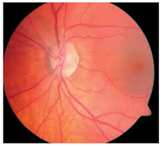 Surgical intervention with a laser is recommended for those people with a detachment persisting more than four months, having recurrent csr or those with previous csr in the other eye. How Serious Is Central Serous