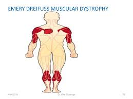 Emery‐dreifuss muscular dystrophy (edmd) is a rare muscular dystrophy, but is particularly important to diagnose due to frequent life‐threatening cardiac complications. Diseases Of Muscles 4 14 2018 Dr Alka Stoelinga Ppt Download