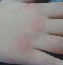 But some bites can carry disease. Papular Urticaria Symptoms Causes And Treatment