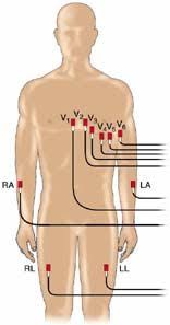 Lead Placement For 12 Lead Allnurses Cardiac Nursing