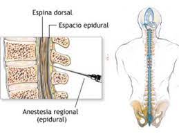 Dolor De Espalda O De Cabeza Despues De Anestesia Epidural Podemos Ayudarte Manuel Raigon Luque