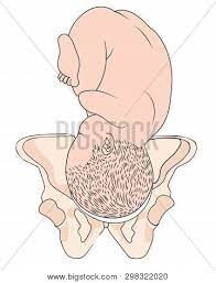 Obstructed labor due to persistent occipitoiliac (position) Left Occiput Anterior Vector Photo Free Trial Bigstock