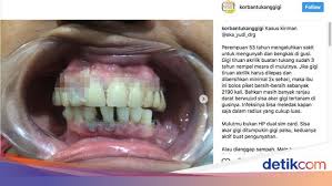 Setelah sekian lama, akhirnya wawa zainal menunaikan juga hasrat anak keduanya itu bagi memiliki gigi yang cantik. Jorok Gigi Tiruan Ini 3 Tahun Tak Pernah Dilepas Pemiliknya