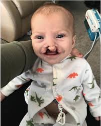 Mom Uplifted By Act Of Kindness After Hurtful Comment About Son's Cleft  Palate