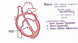 Image result for Ventricular Septal Defect