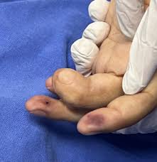 Exogenous Skin Lesions in the Intensive Care Unit: Recognition, Management,  and Prevention Strategies | Current Dermatology Reports