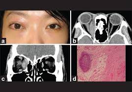 Update In Pathological Diagnosis Of Orbital Infections And Inflammations Lam Choi Vb Yuen Hk Biswas J Yanoff M Middle East Afr J Ophthalmol