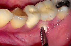 Image result for Periapical Abscess