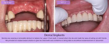 Read more about different types of dental treatments. Natural Dentures Epsom Dental Centre