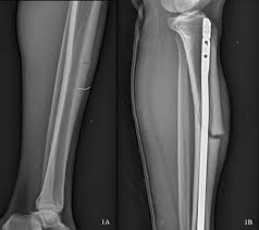 Image result for Tibia Stress Fracture