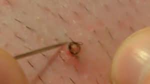 Getting rid of an ingrown hair seems like a pretty minor problem to deal with, one of those things you know you probably shouldn't be doing but the risks feel ingrown hairs are an unfortunately common side effect of trying to remove hair. How To Treat Prevent Ingrown Hairs Youtube