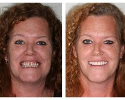 Dentures and Partials