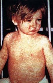 Area vulnerable to measles