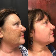 Here is a before and after dot laser treatment that our wonderful  @rmlaesthetics took of her lovely patient. Our dot laser is a #co2laser  that is used to treat fine lines, crepey