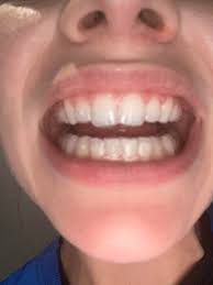 One way to clean your appliance quickly is to use a cleaner such as retainer brite, which is a tablet cleaner that dissolves in water. Scared About Smelly Trays On My First Aligner And I Wear Them For 2 Weeks When Do They Start To Smell I M 1 Week In Today And Don T Want Them To Smell