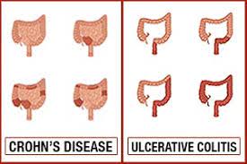 Find updated content daily for popular categories. Crohn S Disease Vs Ulcerative Colitis Differences In Symptoms Causes And Treatment