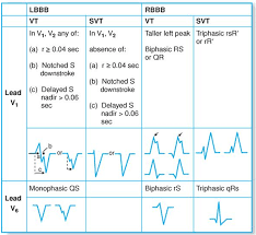 After 25 years, the built wild and always 4x4 suv is rolling off the line at the michigan assembly plant, which underwent a $750 million upgrade and added 2,700 jobs to get the job done. Brugada Algorithm To Differentiate Vt From Svt With Aberrant Conduction Download Table