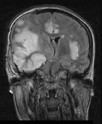 Image result for HSV Encephalitis