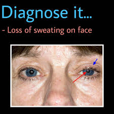 Generalized anhidrosis may occur secondary to congenital absence of sweat glands (ie anhidrosis — sometimes called hypohidrosis — can be difficult to diagnose. Diagnose It Instagram Post Photo Guess The Diagnosis Diagnose It Share This Post In Your Stories Tag Us Dm Us To Buy A Case Series Book Volume 1