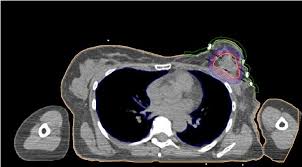 Some researchers are investigating whether breast ct scans could be a better screening tool than traditional mammography. Breast Cancer Transverse Ct Scan With Final Plan Different Isodoses Download Scientific Diagram