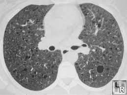 Learning Radiology Lymphangiomyomatosis And Tuberous Sclerosis
