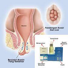 Check spelling or type a new query. Jom Rawat Buasir Dengan Hemooil Posts Facebook