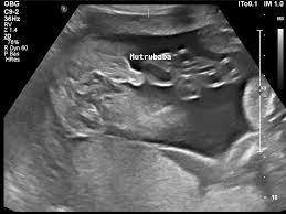 La 18e semaine de grossesse en vidéo. Echo T2 24 Sa Ou 22 Sg En Attendant Bebe