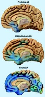Check spelling or type a new query. Alzheimer S Disease Wikipedia