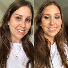 PTPA💕 Huge SHOUTOUT TO OUR DEAR CLIENT MOMMY TESS💕 THANK U SO MUCH🤗  #metime #lovethyself #foreheadfiller #deminishedfinelines #GandangAmarra  #satisfiedclient DM for INQUIRIES 👍 Amarra Aesthetic Studio