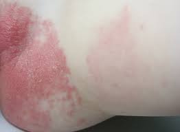 Keeping your baby cool also means checking your baby's body temperature frequently. Baby Acne Symptoms How To Treat Baby Acne On Face