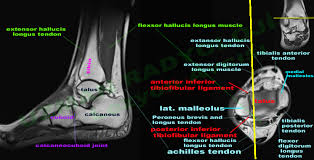 Mri of the soft tissues of the foot visualizes the fat cushions of the sole, heels, fingers and can show swelling, foci of infiltration and inflammation. Mri Ankle Google Search Medical Anatomy Mri Foot Anatomy