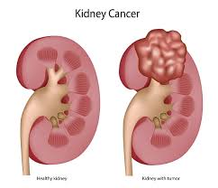 kidney masses overview symptoms diagnosis treatment options