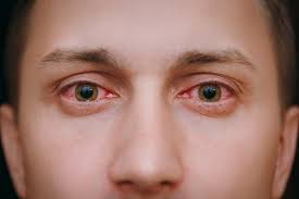 Why Do Your Eyes Get Red When You Smoke Weed Leafbuyer