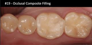 Image result for Occlusal