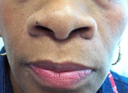It is seen on the nose, ears, cheeks, lips, and forehead. Successful Long Term Management Of Refractory Cutaneous And Upper Airway Sarcoidosis With Periodic Infliximab Infusion