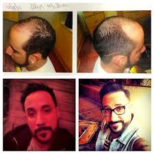 Whether you are a wife or a. Backstreet Boy S A J Mclean Bald No Longer Hair Transplant Success Photos Celeb Dirty Laundry