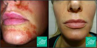 Philadelphia Pa Chemical Burn Treatment Face Treatment Face Products Skincare