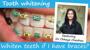 Whiter teeth are something that many people desire. Can You Have Teeth Whitening With Braces On Youtube