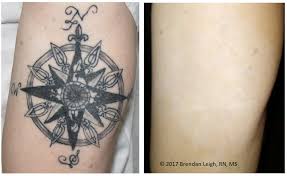 Any natural exfoliator will scrub your dead and excess skin. Picosure Removal Of Modern Black Ink Line Drawing Tattoos Austinpicosure Com A Tattoo Removal Nurse S Notes