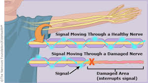 Weakness and tingling in your extremities are usually the first symptoms. Guillain Barre Syndrome