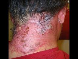 The skin exposed to the ppd may become red, swollen, blistered, dry, thickened and cracked. Effective Home Remedies To Treat Hair Dye Allergies Youtube