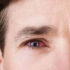 Image result for Allergic Conjunctivitis