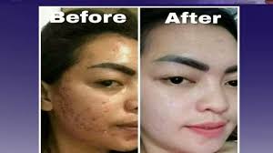 Tersedia Dalam Kemasan 5ml 15 Ml Dan 120 Ml All In One Product Produk Yang Praktis Karena Anda Tidak Perlu Lagi Kerepotan Da Wajah Jerawat Perawatan Kulit